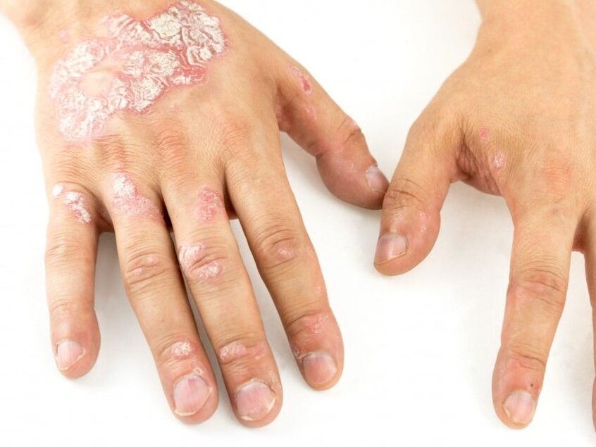 psoriasis en las manos